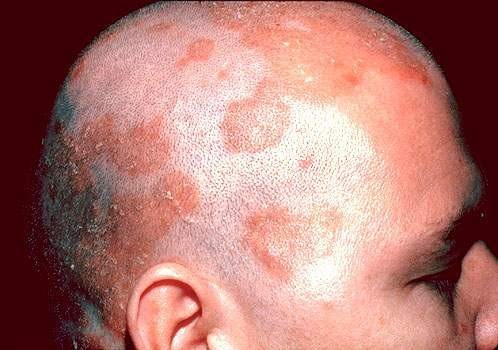 Dermatitida na lidské hlavě